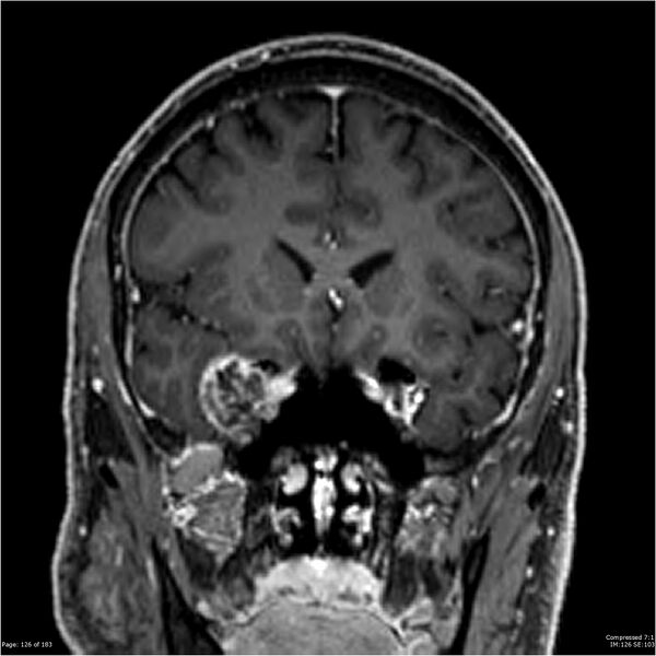 File:Chondrosarcoma of skull base- grade II (Radiopaedia 40948-43654 Coronal T1 C+ 37).jpg