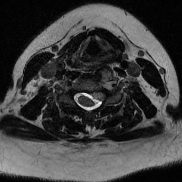 File:Chordoma - cervical spine (Radiopaedia 70084-80111 Axial T2 52).png