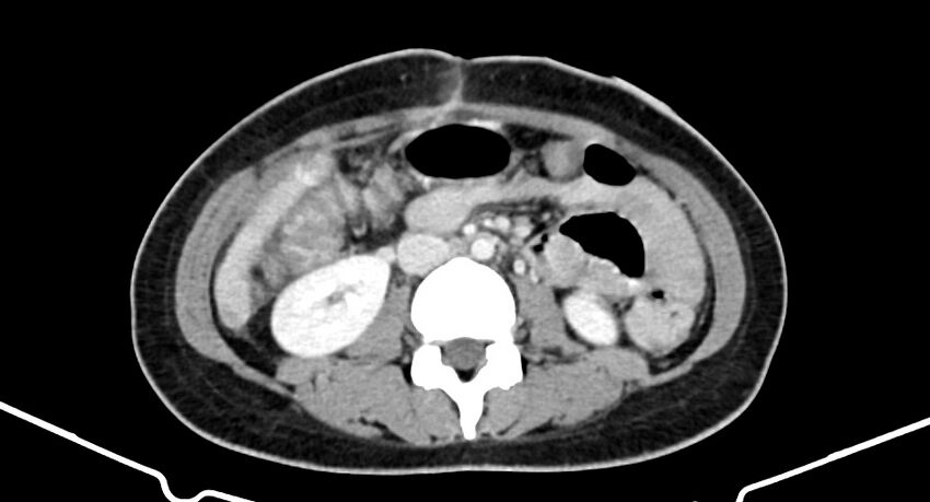 Choriocarcinoma liver metastases (Radiopaedia 74768-85766 A 113).jpg