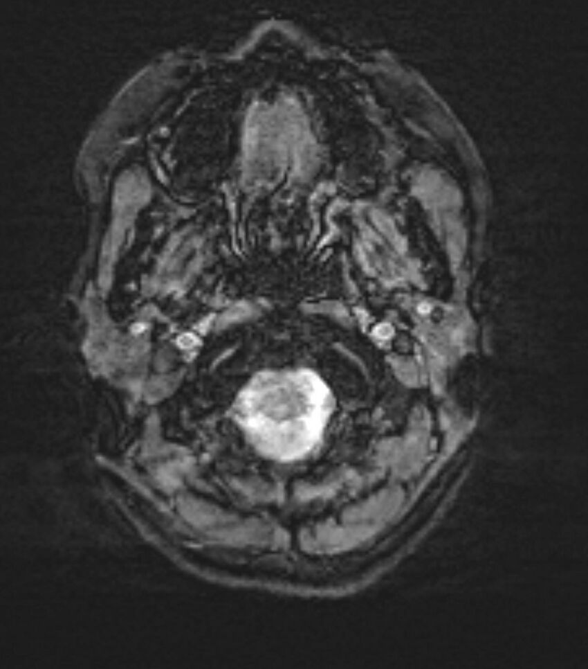 Choroid plexus carcinoma (Radiopaedia 91013-108553 Axial SWI 4).jpg