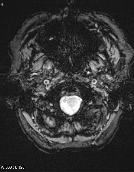 File:Chronic lymphocytic inflammation with pontine perivascular enhancement responsive to steroids (CLIPPERS) (Radiopaedia 37520-39374 Axial SWI 3).jpg
