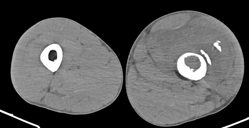 Chronic osteomyelitis (with sequestrum) (Radiopaedia 74813-85822 D 93).jpg