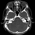 Chronic otomastoiditis (Radiopaedia 27138-27309 Axial non-contrast 31).jpg