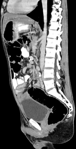 File:Chronic small bowel volvulus (Radiopaedia 75224-86322 C 70).jpg