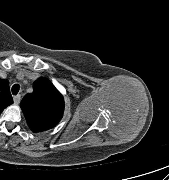 File:Clear cell chondrosarcoma - humerus (Radiopaedia 63104-71612 Axial non-contrast 39).jpg