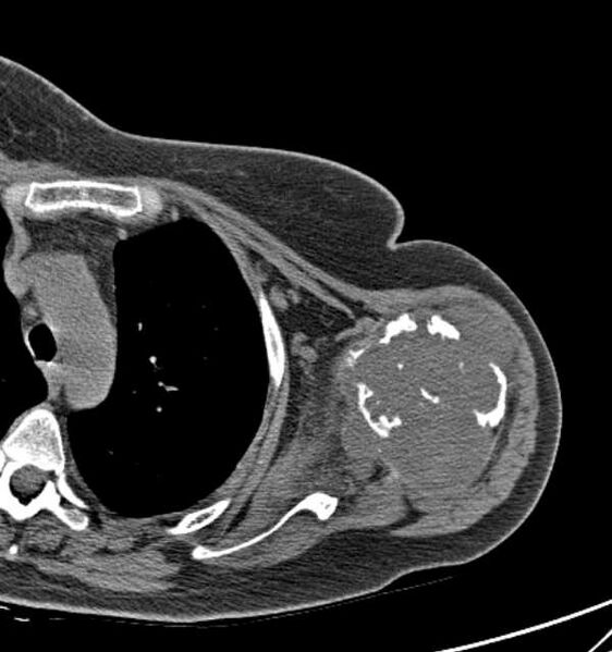 File:Clear cell chondrosarcoma - humerus (Radiopaedia 63104-71612 Axial non-contrast 52).jpg