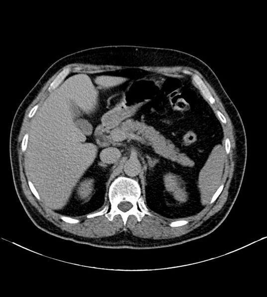 File:Clear cell renal cell carcinoma (Radiopaedia 85006-100539 H 6).jpg