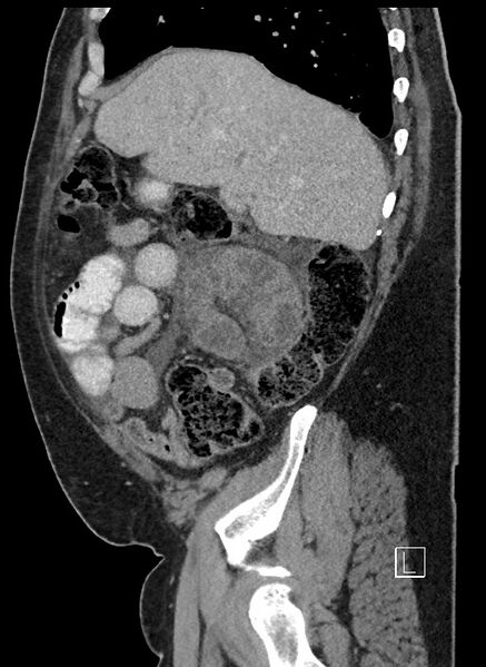 File:Closed loop obstruction - internal hernia into nephrectomy bed (Radiopaedia 59867-67320 C 81).jpg