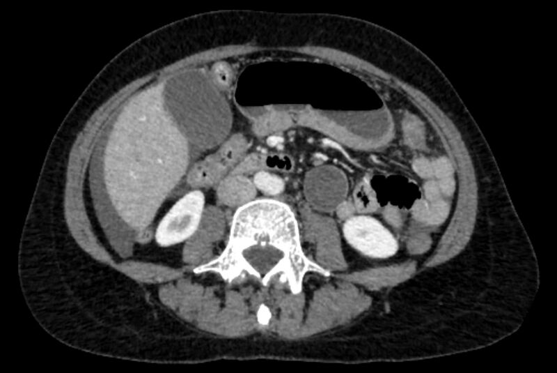 File:Closed loop small bowel obstruction (Radiopaedia 71211-81508 A 61).jpg