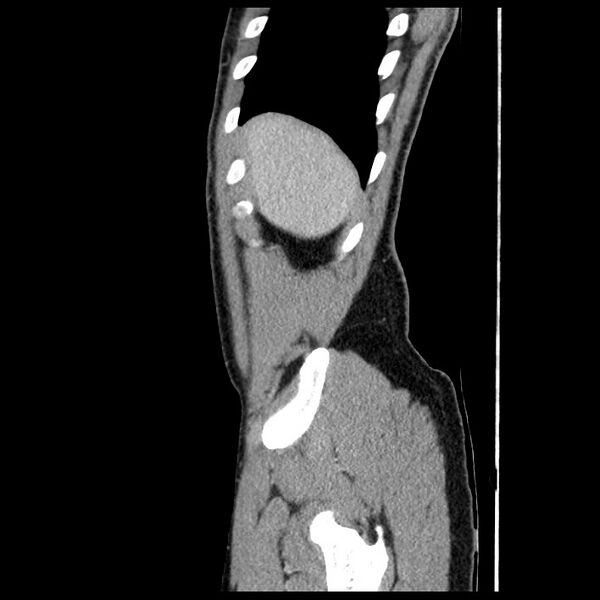 File:Co-existing acute appendicitis and epiploic appendagitis (Radiopaedia 61789-69911 B 9).jpg