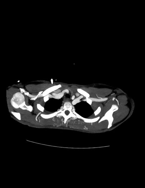 File:Coarctation of the aorta (Radiopaedia 27458-27657 D 4).jpg