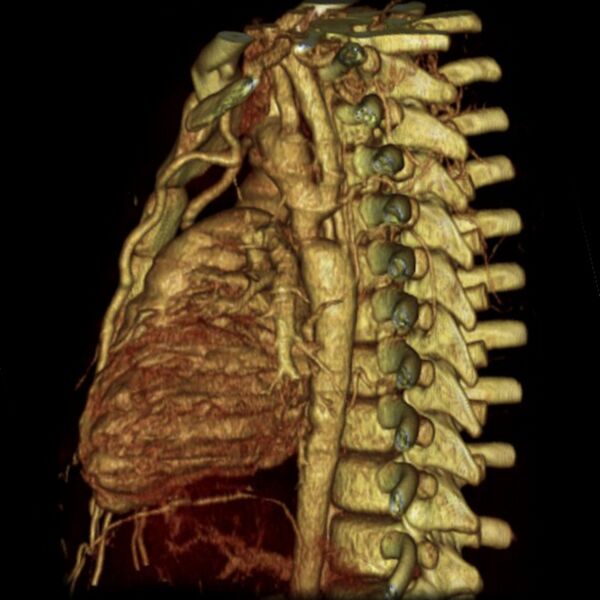 File:Coarctation of the aorta (Radiopaedia 6279-7684 D 1).jpg