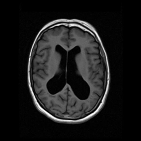 File:Colloid cyst with hydrocephalus (Radiopaedia 9373-10065 Axial T1 11).jpg