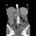 Colocolic fistula - Crohn disease (Radiopaedia 57063-63955 B 23).jpg