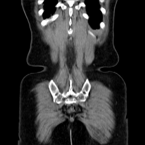File:Colon carcinoma with hepatic metastases (Radiopaedia 29477-29961 B 40).jpg