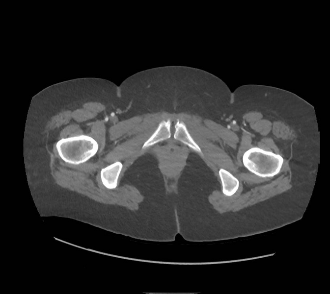File:Colonic pseudo-obstruction (Radiopaedia 79752-92980 A 196).png