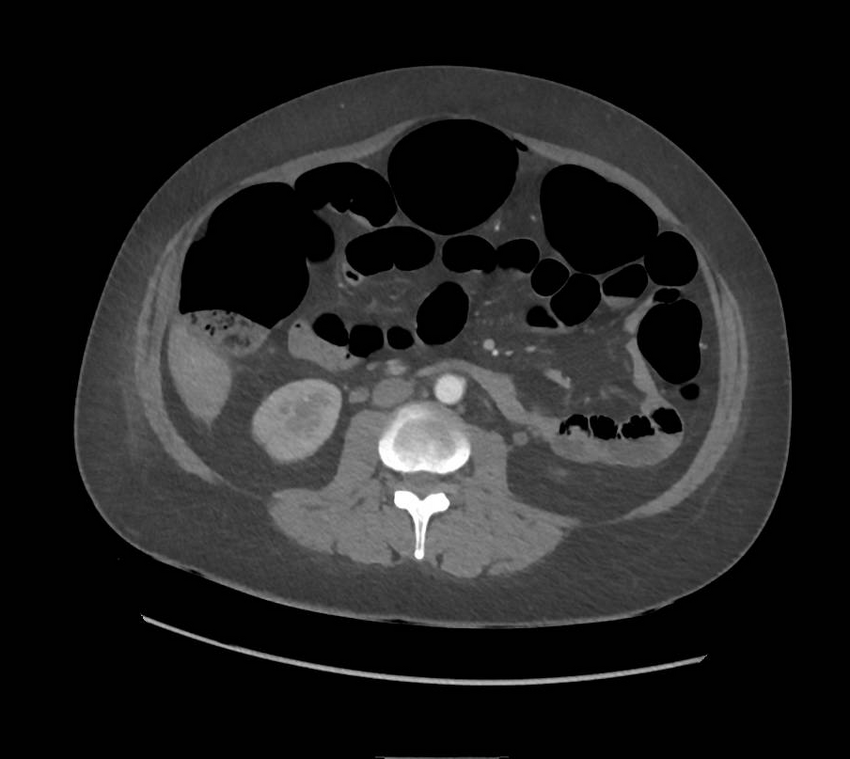 Colonic pseudo-obstruction (Radiopaedia 79752-92980 A 95).png