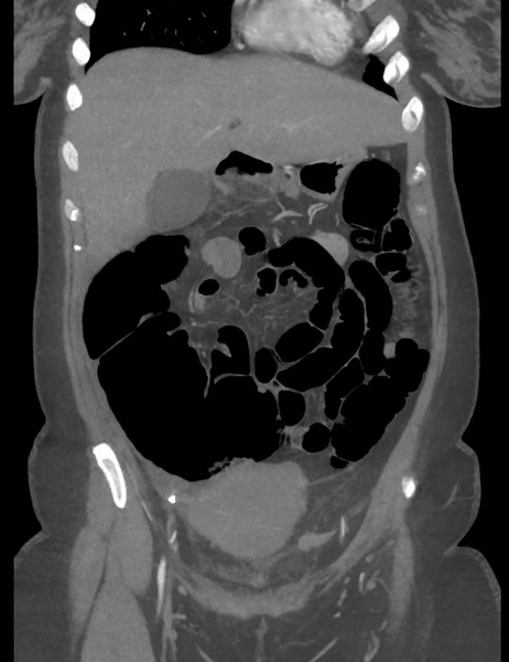File:Colonic pseudo-obstruction (Radiopaedia 79752-92980 B 24).png
