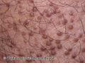 Lichen amyloidosis (DermNet NZ lichen-amyloidosis-11).jpg