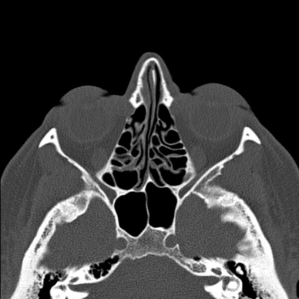 File:Nasal septal perforation (Radiopaedia 25030-25289 Axial bone window 33).jpg
