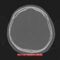 Nasopharyngeal carcinoma recurrence - skull base destruction (Radiopaedia 29107-29490 Axial bone window 35).jpg