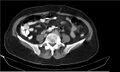 Necrotizing pancreatitis (Radiopaedia 20595-20495 Axial C+ delayed 30).jpg