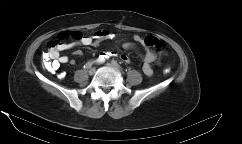 File:Necrotizing pancreatitis (Radiopaedia 20595-20495 Axial C+ delayed 30).jpg