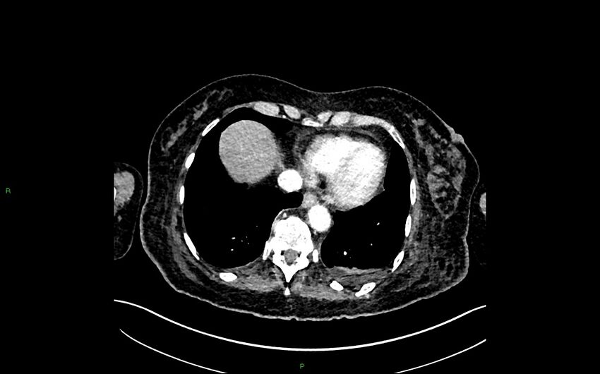 Neo-terminal ileal stricture (Crohn disease) (Radiopaedia 33790-34948 A 20).jpg