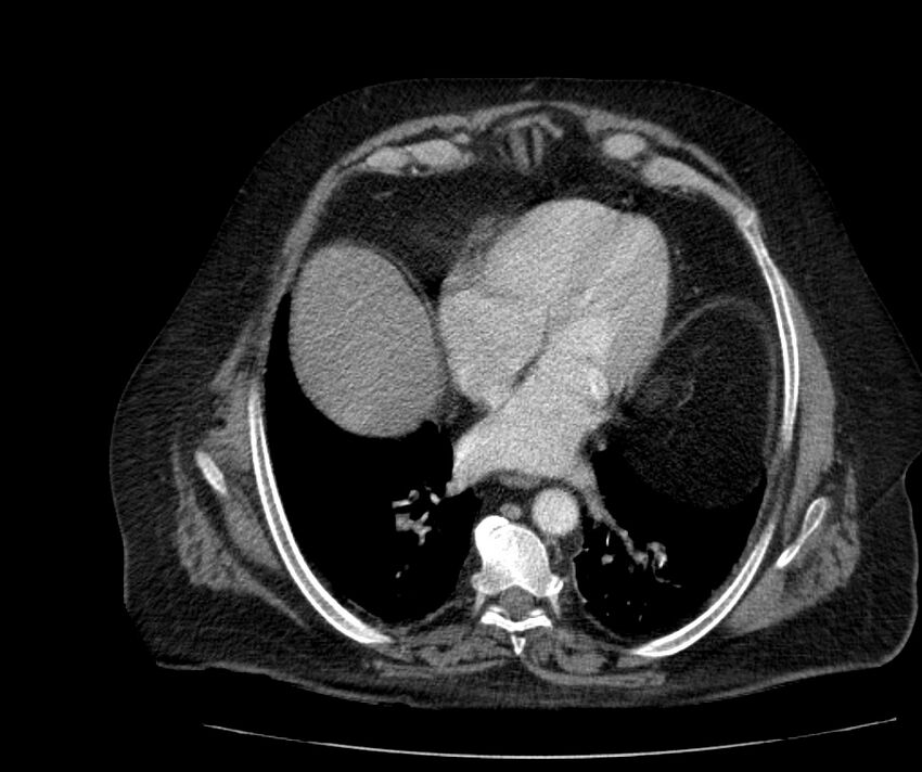 Nephroptosis with inguinal hernia containing perirenal fat (Radiopaedia 56632-63391 C 35).jpg