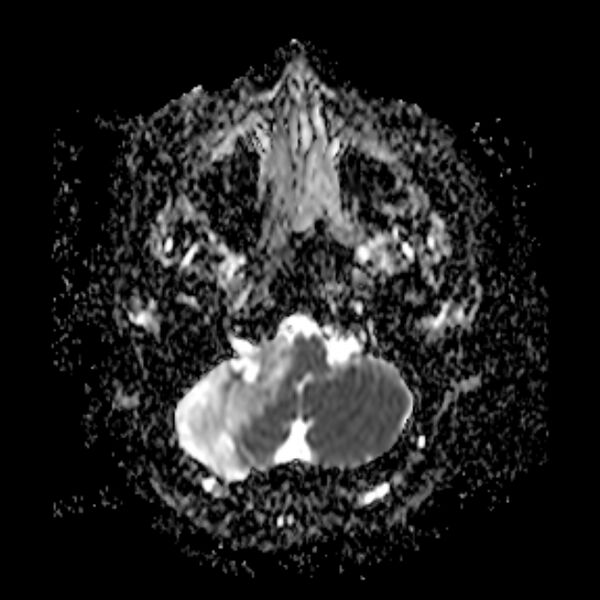 File:Neurofibromatosis type 2 (Radiopaedia 67470-76871 Axial ADC 4).jpg
