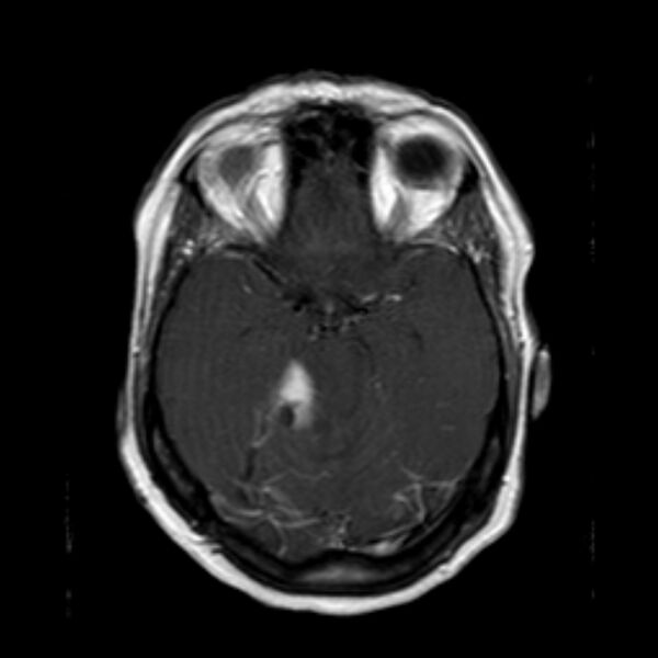 File:Neurofibromatosis type 2 (Radiopaedia 67470-76871 Axial T1 C+ 9).jpg