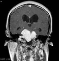 Neurofibromatosis type 2 - cranial and spinal involvement (Radiopaedia 5351-7111 Coronal T1 C+ 7).jpg