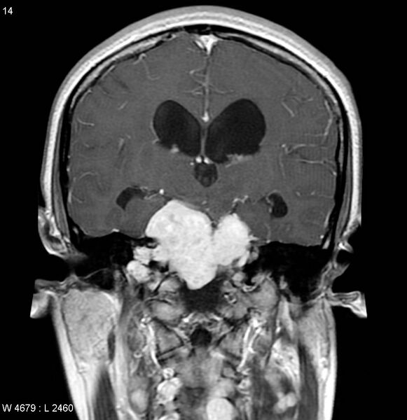File:Neurofibromatosis type 2 - cranial and spinal involvement (Radiopaedia 5351-7111 Coronal T1 C+ 7).jpg