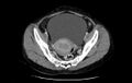 Non-puerperal uterine inversion (Radiopaedia 78343-91094 A 15).jpg