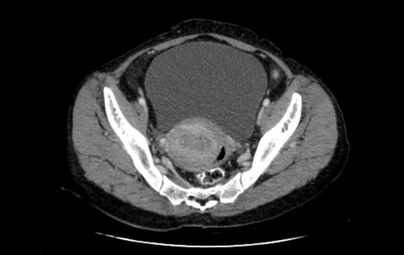 File:Non-puerperal uterine inversion (Radiopaedia 78343-91094 A 15).jpg