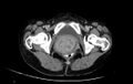 Non-puerperal uterine inversion (Radiopaedia 78343-91094 A 77).jpg