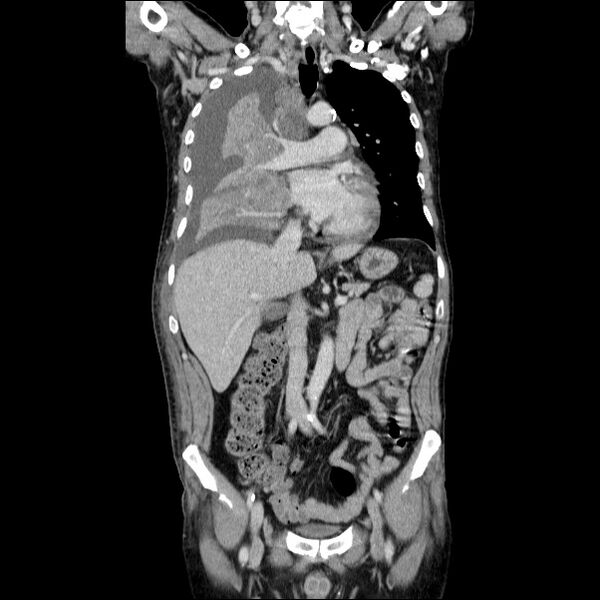 File:Non small-cell lung cancer (Radiopaedia 24467-24769 Coronal C+ delayed 28).jpg