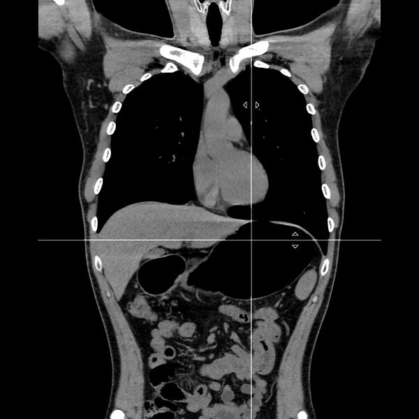 File:Normal CT virtual gastroscopy (Radiopaedia 29960-30501 D 3).jpg