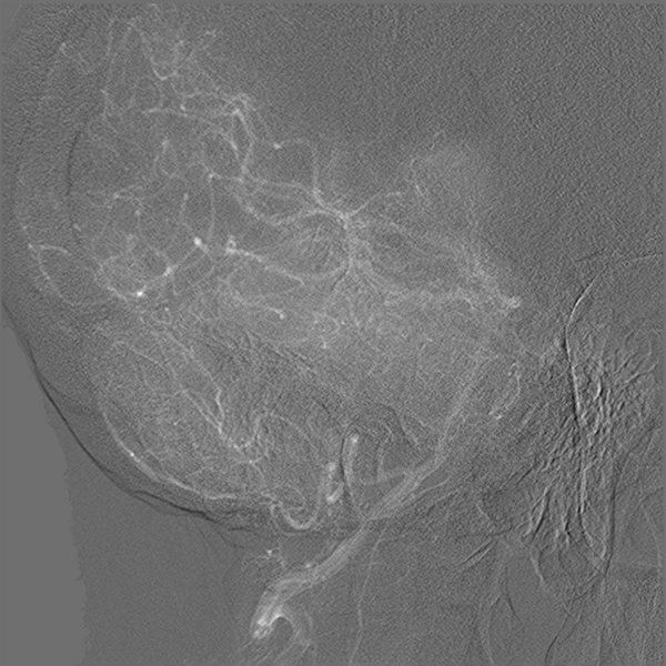 File:Normal cerebral angiogram (four vessel DSA) (Radiopaedia 41708-44649 O 12).png