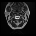 Normal cervical and thoracic spine MRI (Radiopaedia 35630-37156 Axial T2 27).png
