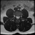 Normal lumbar spine MRI (Radiopaedia 35543-37039 Axial T2 23).png