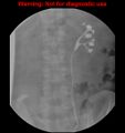 Normal retrograde pyelography of a native and transplant kidney (Radiopaedia 40480-43054 Native kidney 29).jpg