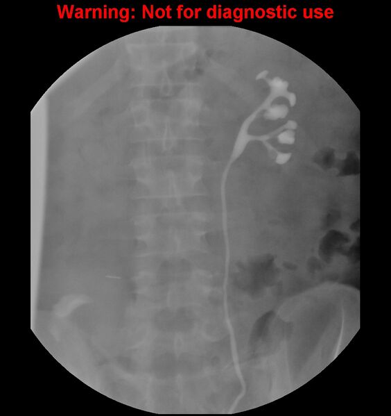 File:Normal retrograde pyelography of a native and transplant kidney (Radiopaedia 40480-43054 Native kidney 29).jpg