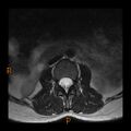 Normal spine MRI (Radiopaedia 77323-89408 Axial T2 1).jpg