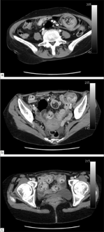 Axial CT scans of the abdomen showing multiple intussusceptions in the jejunum