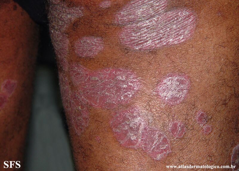 File:Psoriasis (Dermatology Atlas 114).jpg