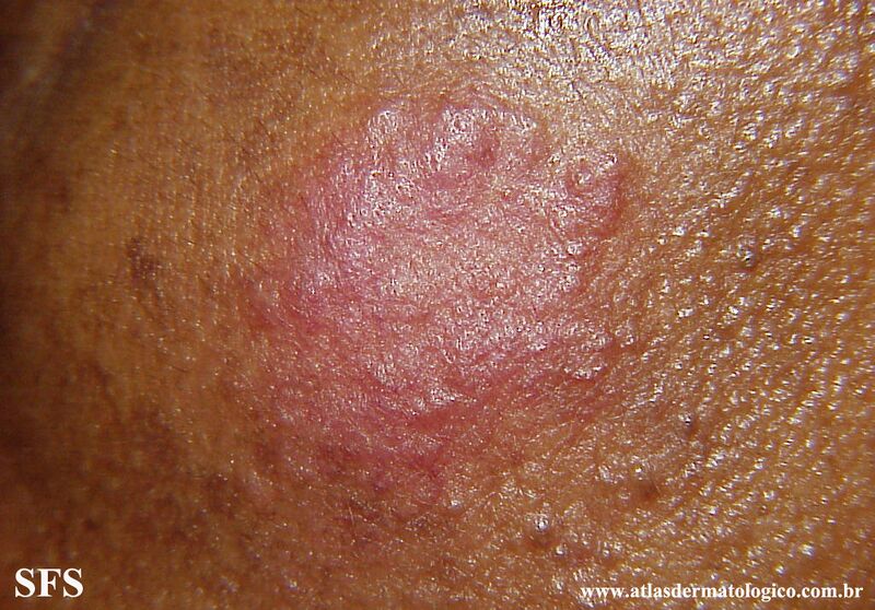 File:Sarcoidosis (Dermatology Atlas 35).jpg