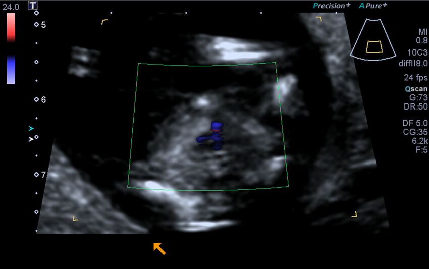 1st trimester nuchal-morphology ultrasound (Radiopaedia 44706-48477 Heart views cine with colour 158).jpg