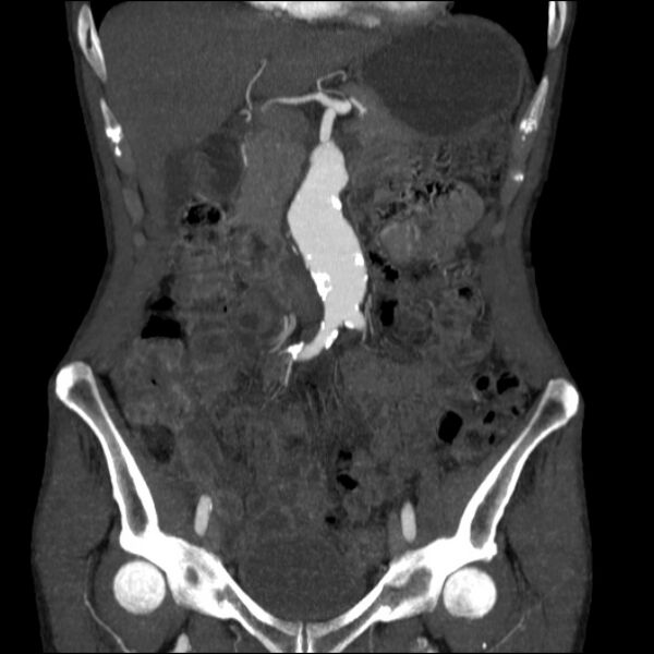 File:Abdominal aortic aneurysm (Radiopaedia 23703-23856 Coronal C+ arterial phase 9).jpg