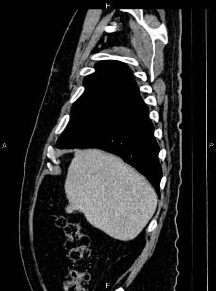 File:Abdominal aortic aneurysm (Radiopaedia 83094-97462 Sagittal renal cortical phase 24).jpg